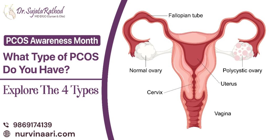 PCOS Awareness Month Sujata Rathod