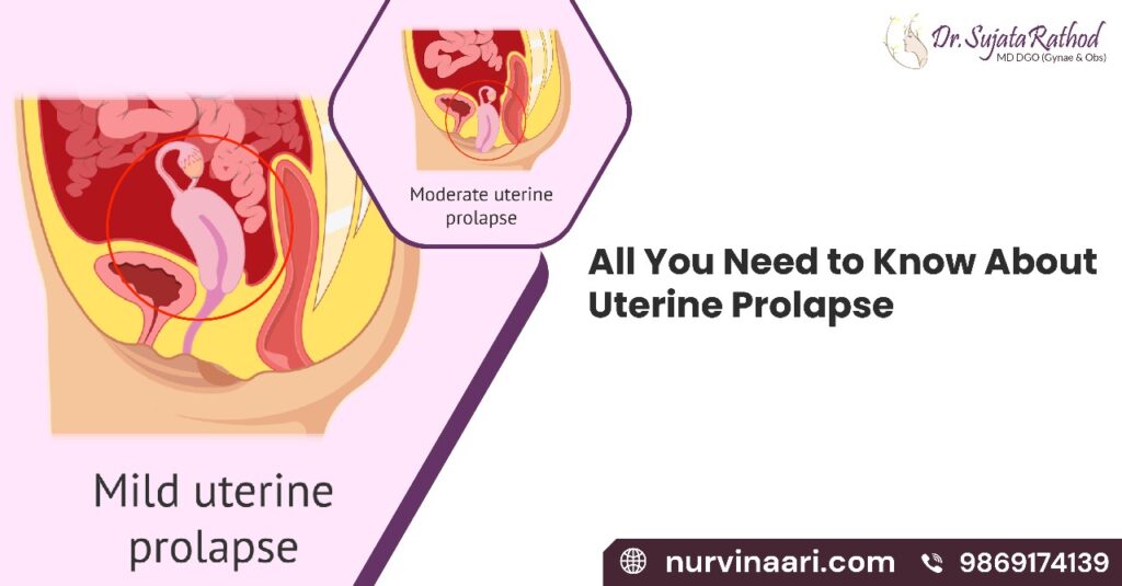 Uterine Prolapse Treatment In Thane