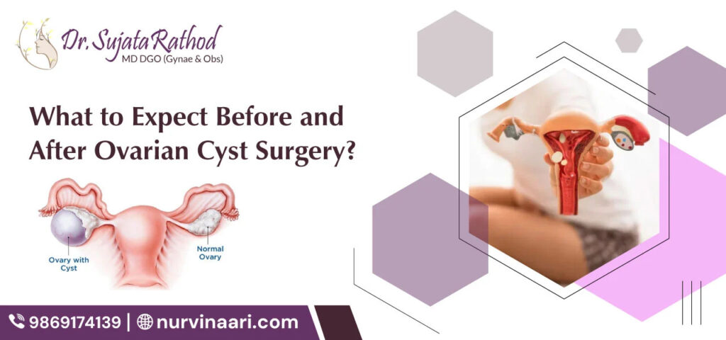 Ovarian Cyst surgery in Thane