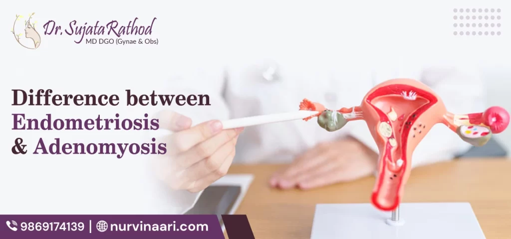 Difference between Endometriosis and Adenomyosis