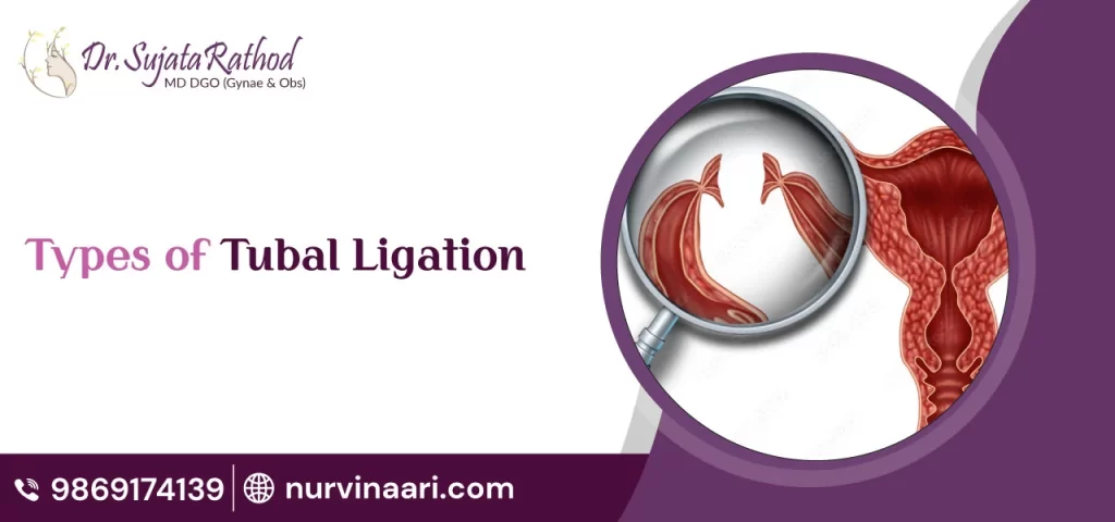 Types-of-Tubal-Ligation