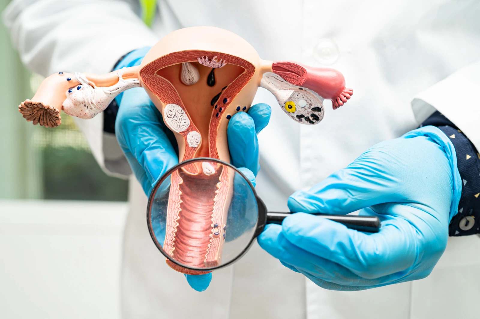 Laparoscopic Myomectomy in Thane