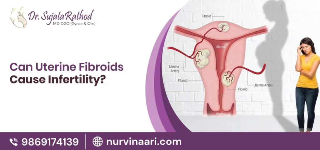 Can Uterine Fibroids Cause Infertility?