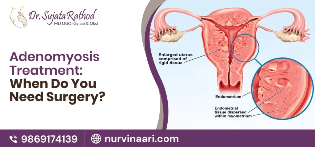 adenomyosis-treatment-when-do-you-need-surgery