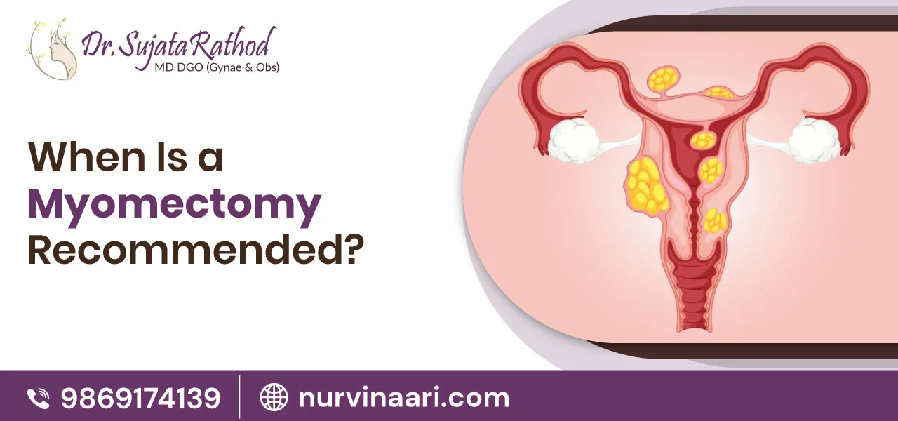 When Is a Myomectomy Recommended?