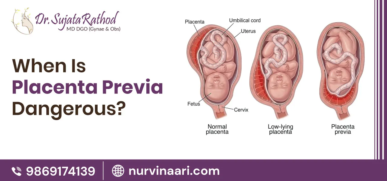 When Is Placenta Previa Dangerous?